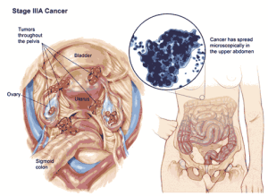 kanker-rahim-